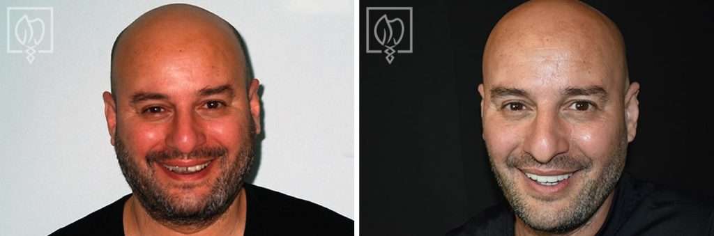 Patient's Teeth Were Neglected and Broken Down as He Avoided Dental Appointments