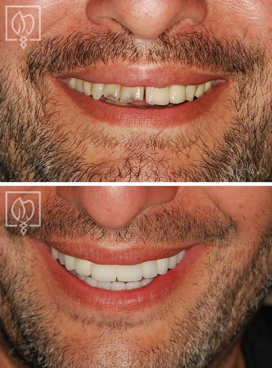 A Revitalized Smile Creating A Recharged Confidence Before After