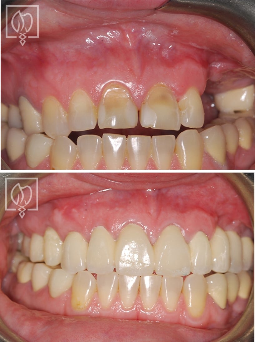 Cosmetic Smile Makeover Full Arch Reconstruction With Smile Makeover Implant Reconstruction Complex Reconstruction Case 2