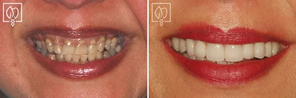 For 30 Years, Our Patient Suffered with Teeth That Were Very Dark Due to Tetracycline Staining