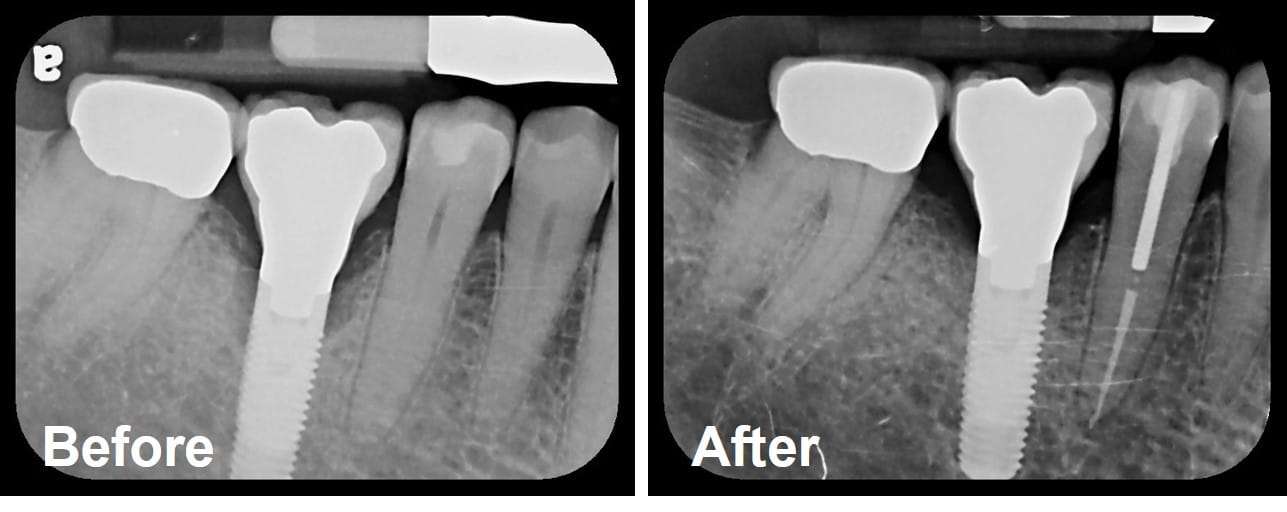 Can a Failing Dental Implant Be Saved or Repaired?