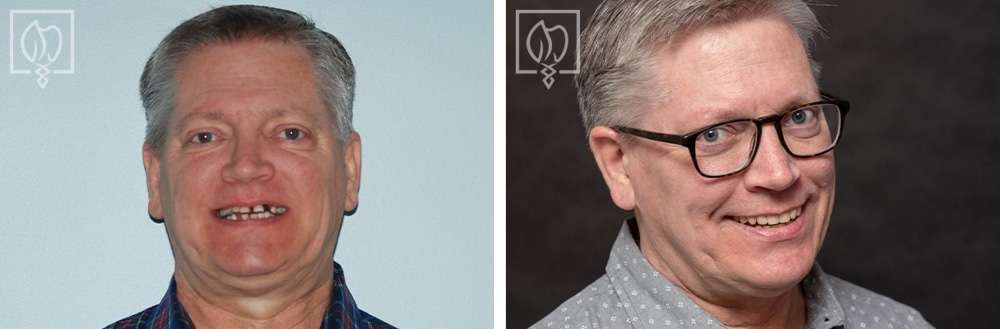 All-on-4 dental implant procedure before and after comparison