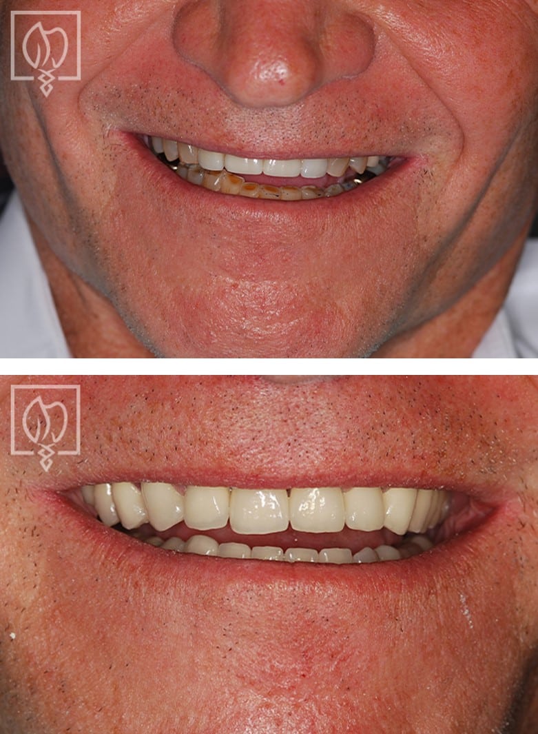 Complex Reconstruction Case 1880 Before After 2