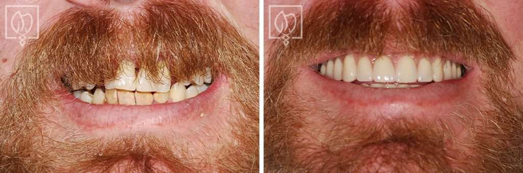 Addressing Patient’s Bone Loss with Extensive Bone Grafting for Dental Implants