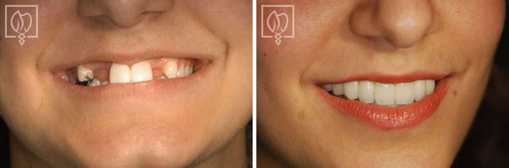 Treating Congenitally Missing Teeth in a Teenager with Dental Implants