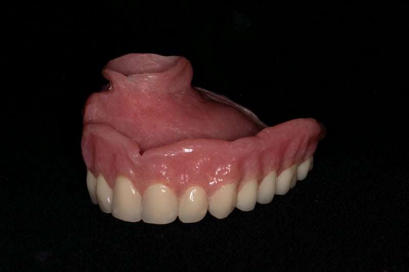 Understanding Palatal Obturators and How They Can Address Openings in the Roof of the Mouth