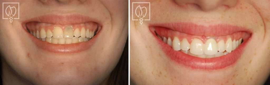 Replacing a Discolored Front Tooth with a Precision Placed Implant