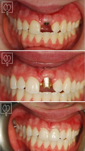 Front Tooth Replacement With An Implant 3 1838 Teeth Rotrosen Scaled E1693517097315