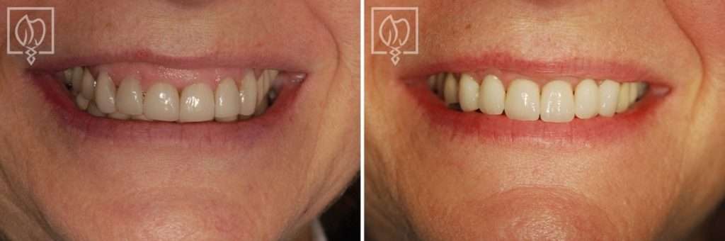 Patient Was Dissatisfied With Her 'Gummy' Smile