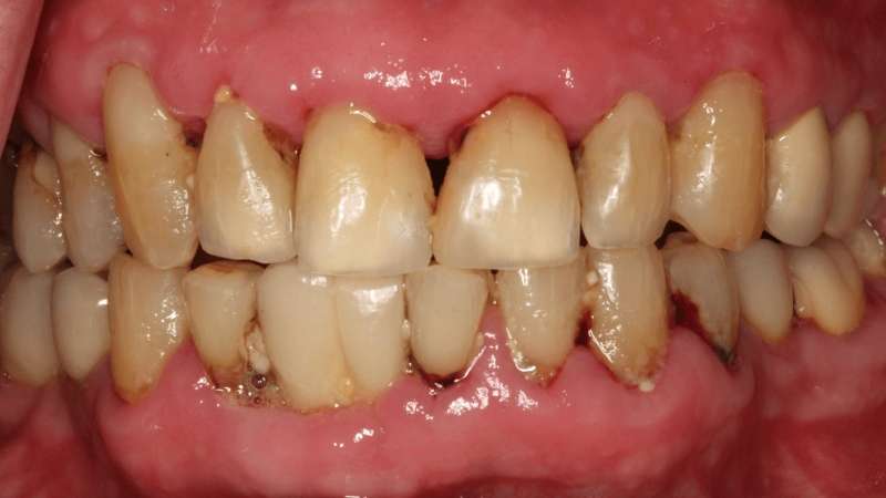Common Misconceptions About Signs and Treating Gum (Periodontal) Disease