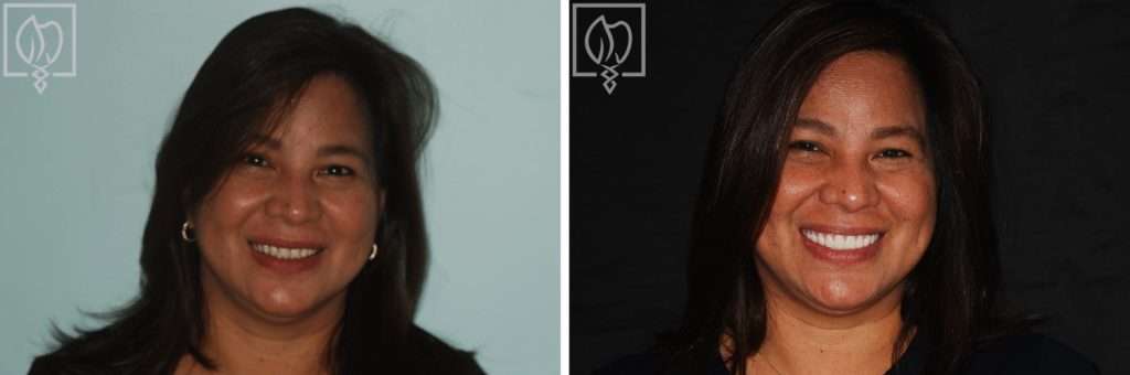 Rejuvenating Maria’s Severely Worn Down Implant Overdentures