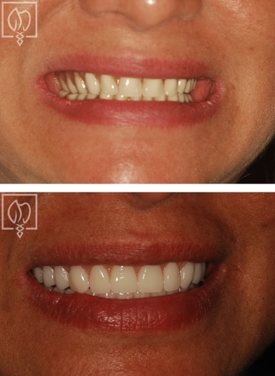 Calomiris M Before And After Smile 1