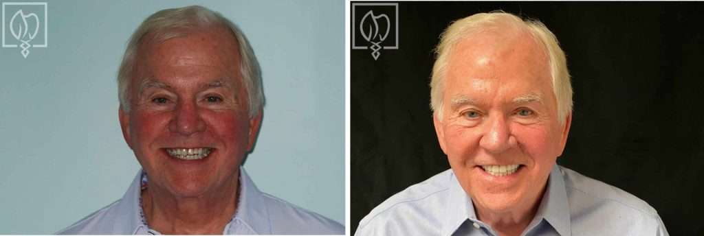 Before: A Smile Transformation in Just Four Months: A Patient’s Dental Crown Restoration for a TV Series