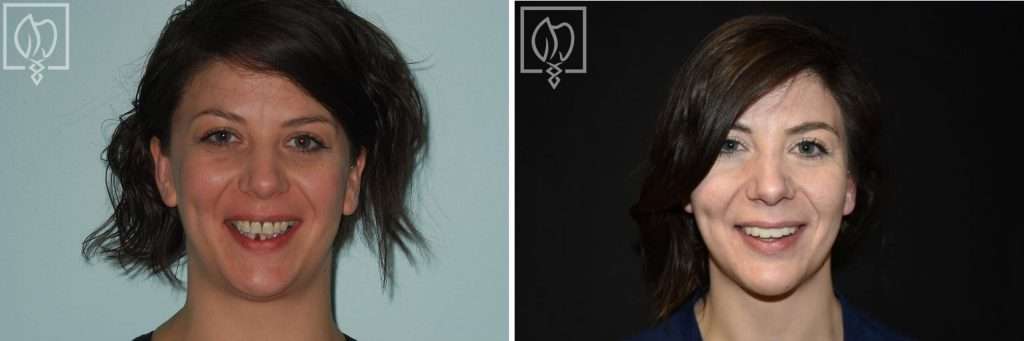 Salvaging Ms. N’s Severely Broken-Down Upper and Lower Teeth from Gum and Bone Disease