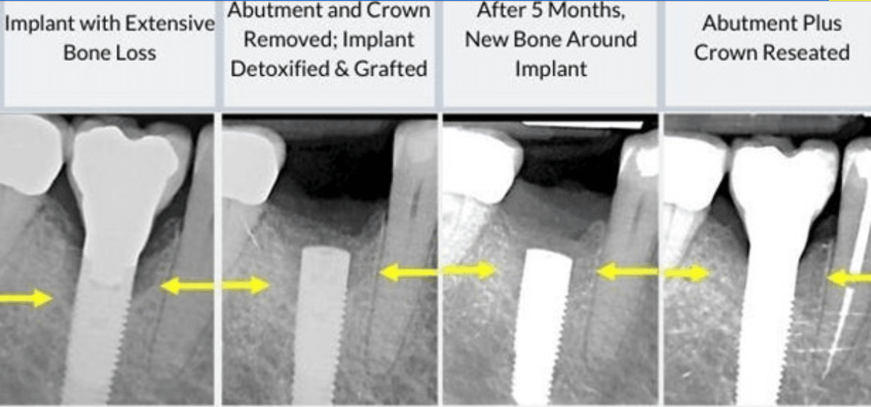 What Causes Failed Dental Implants Due to Bone Loss?