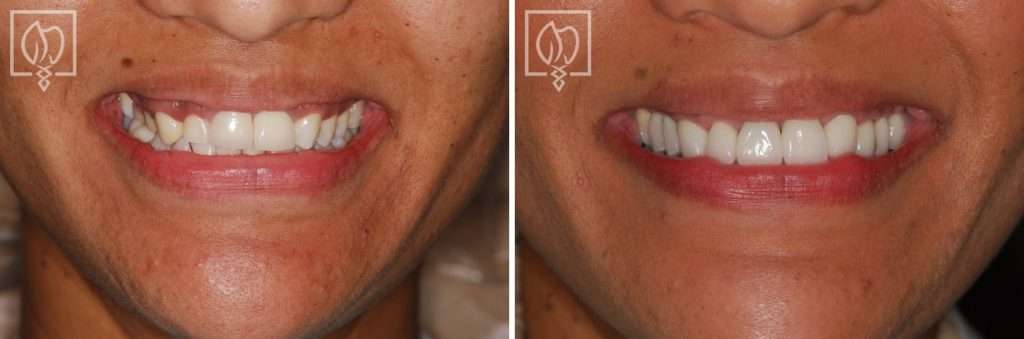 Multi-Faceted Treatment for Patient Unhappy With Her Artificial-Looking Crowns, Teeth and Gums