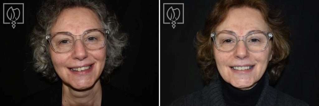 Temporary Crowns Restore Patient's Smile in Just One Day with an Immediate Smile Makeover