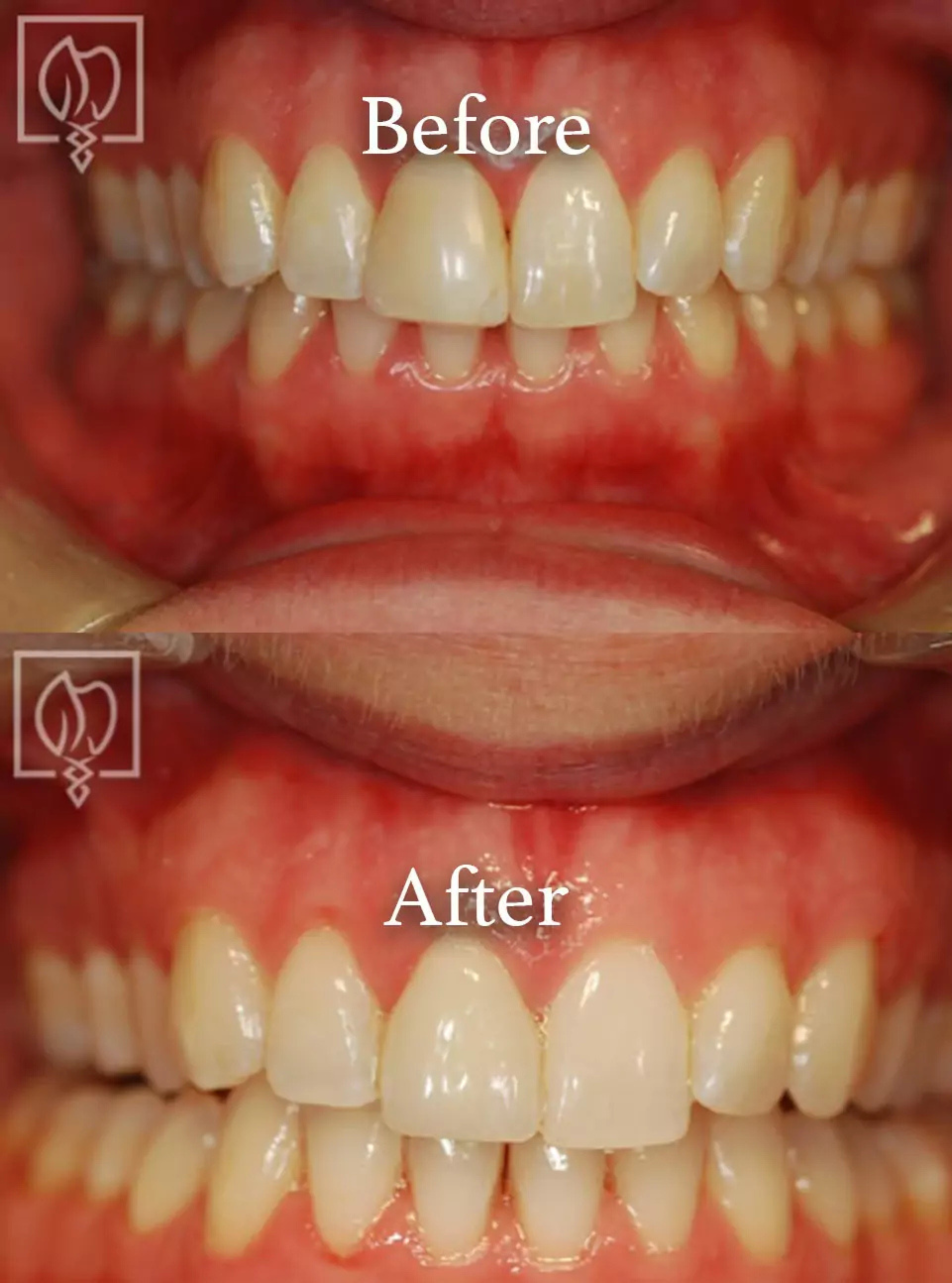 Cosmetic smile makeover before and after case 3