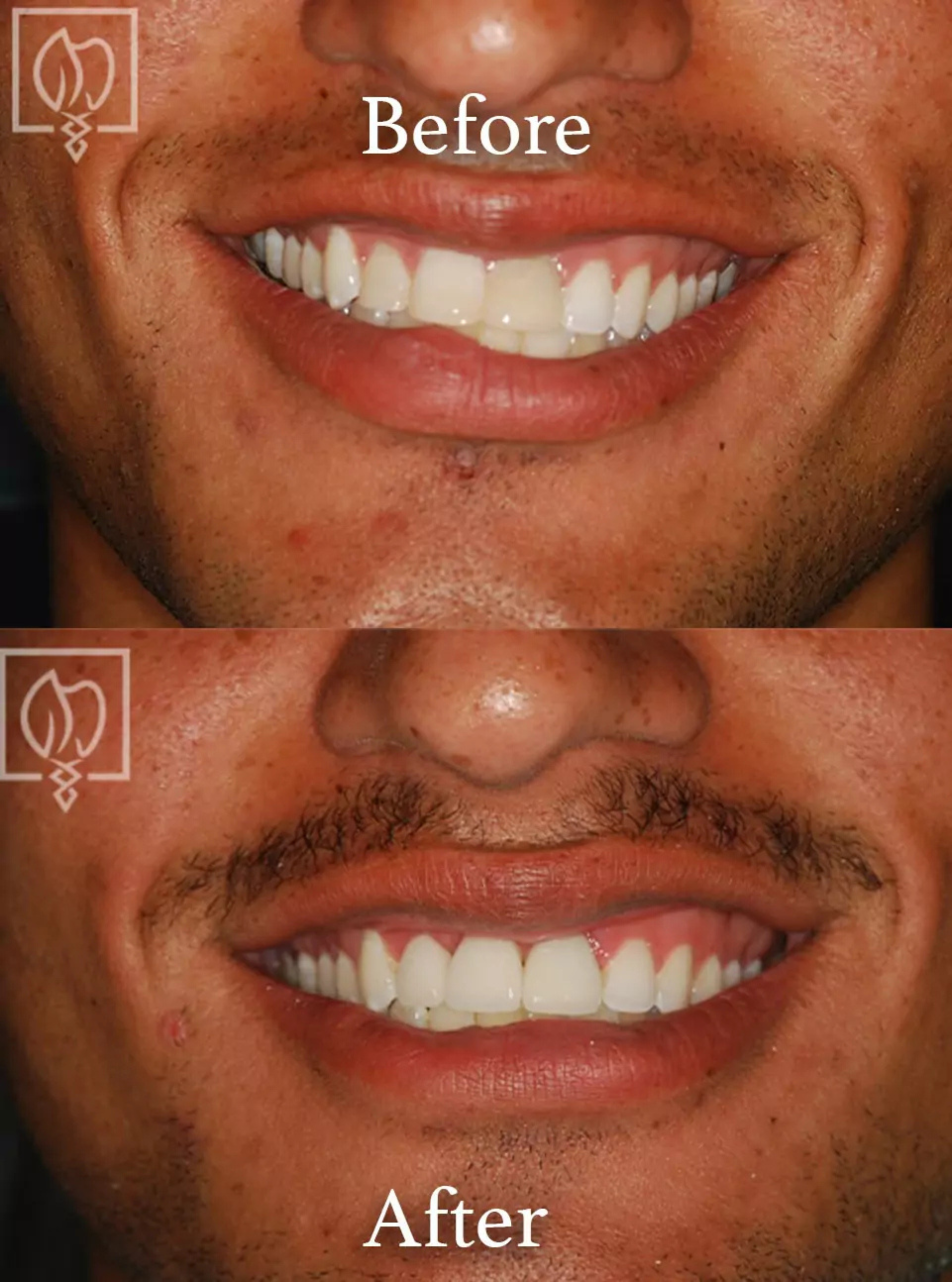 Cosmetic smile makeover before and after case 10