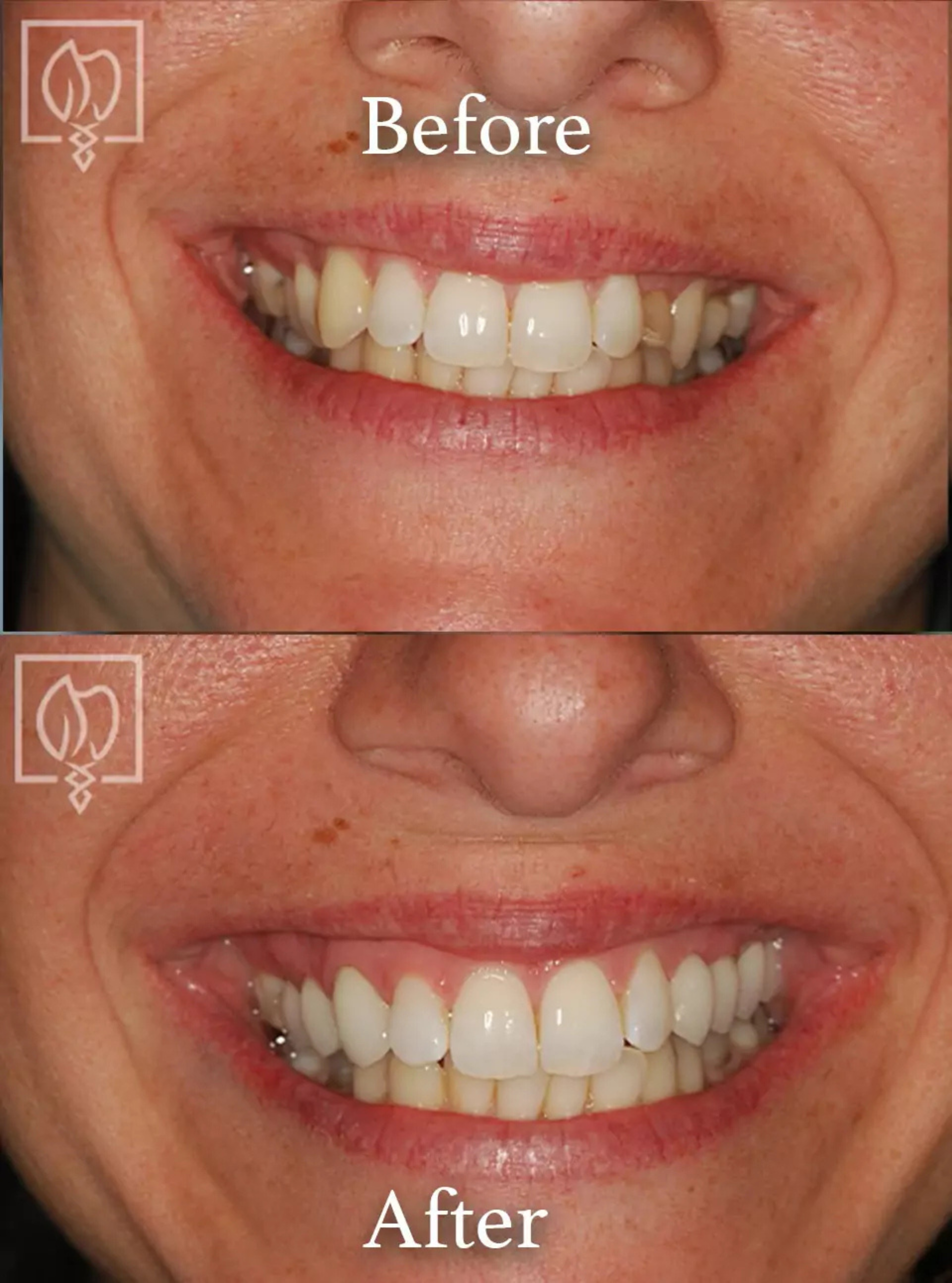 Cosmetic smile makeover before and after case 11