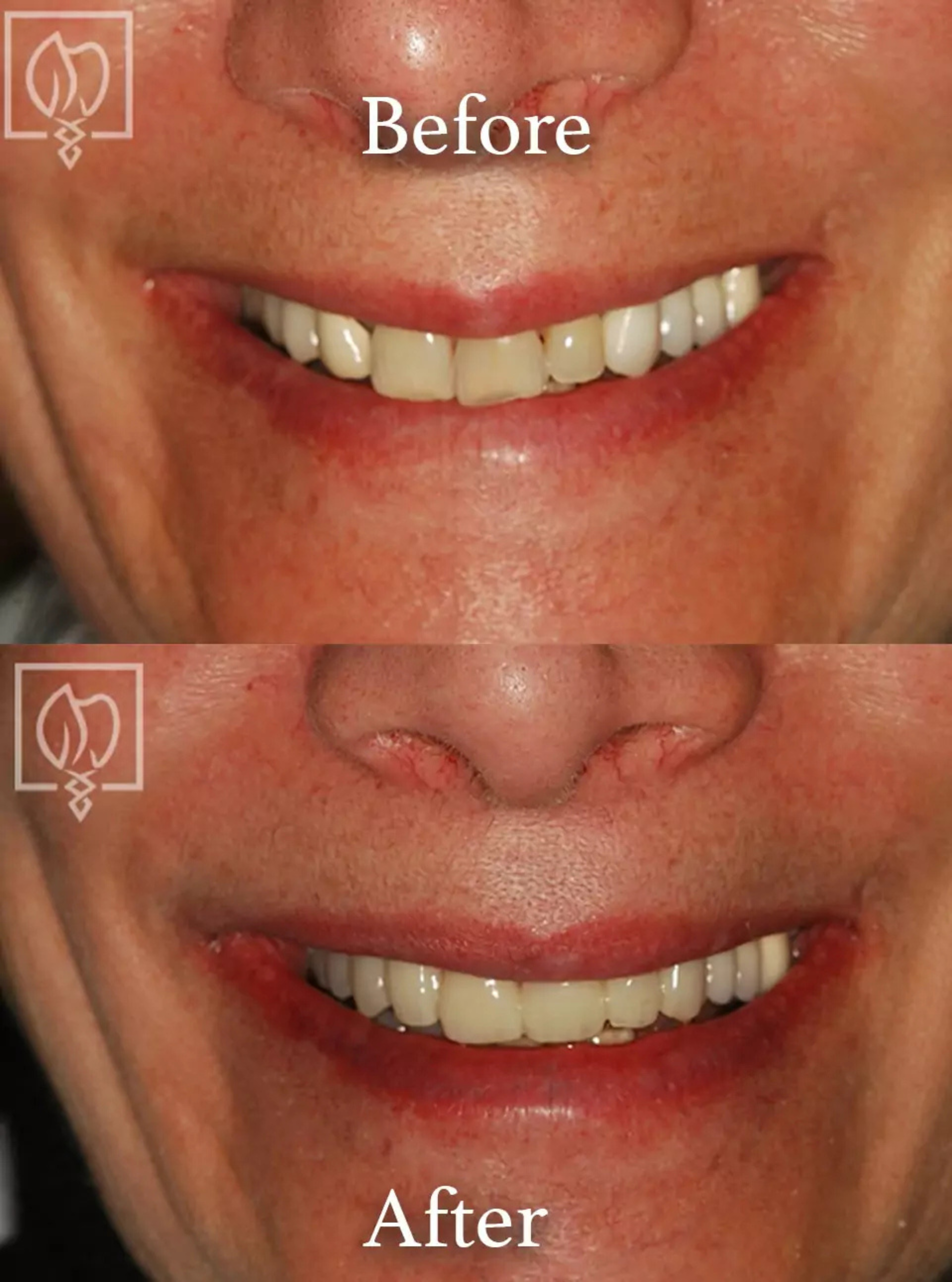 Cosmetic smile makeover before and after case 4