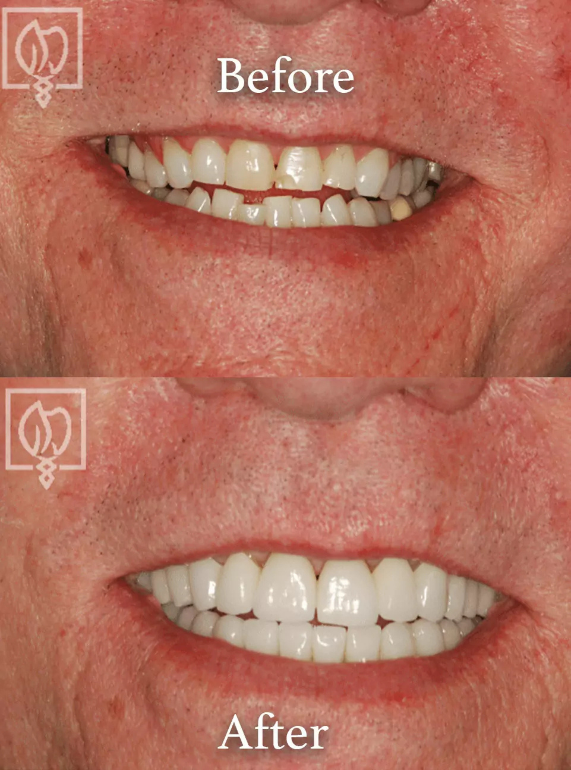 Cosmetic smile makeover before and after case 5