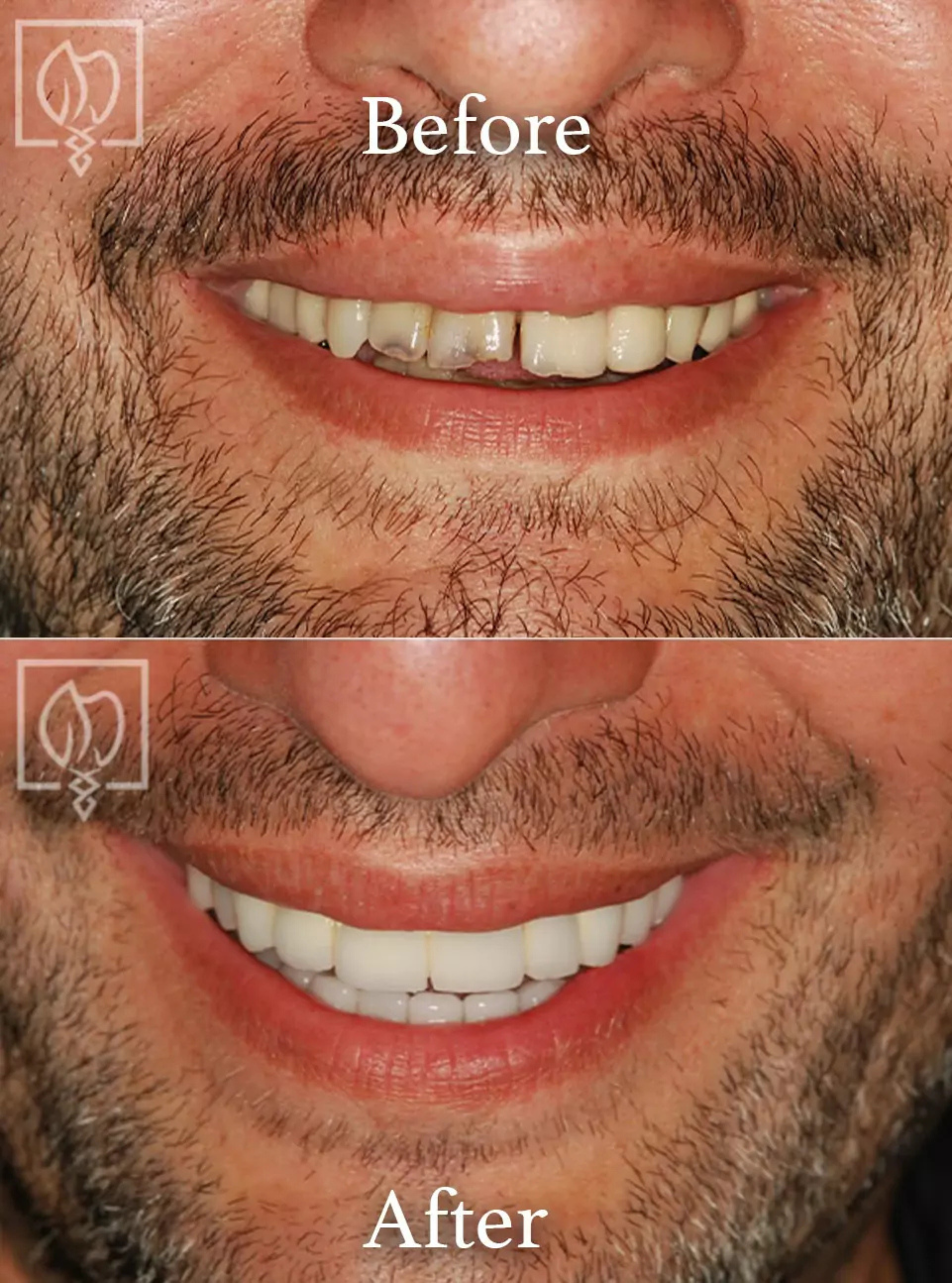 Cosmetic smile makeover before and after case 6