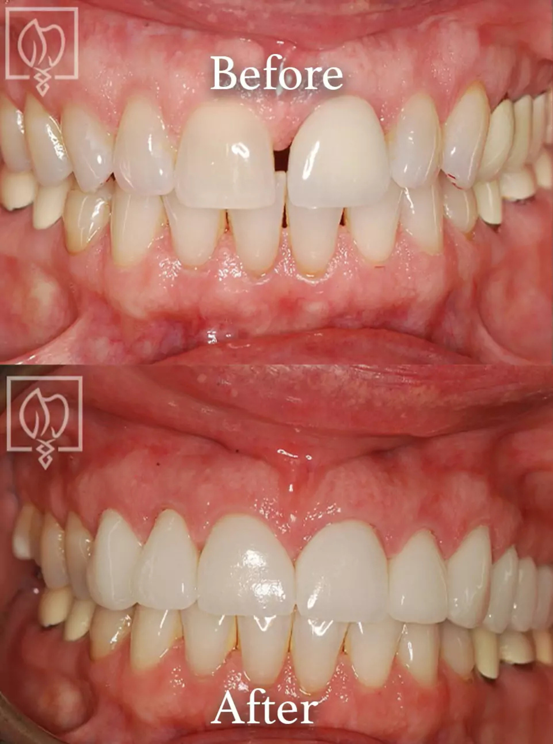 Cosmetic smile makeover before and after case 7