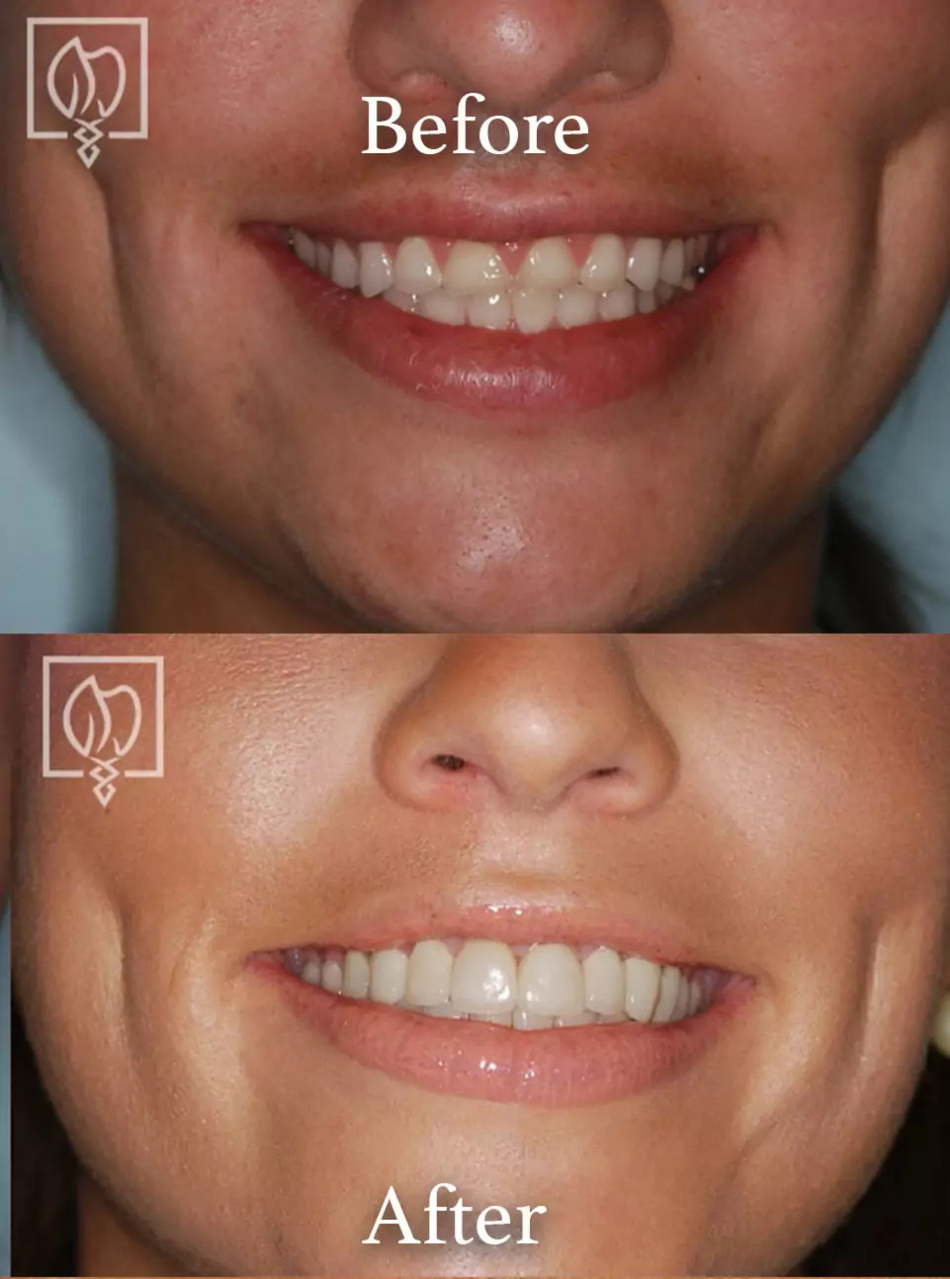 Cosmetic smile makeover before and after case 9