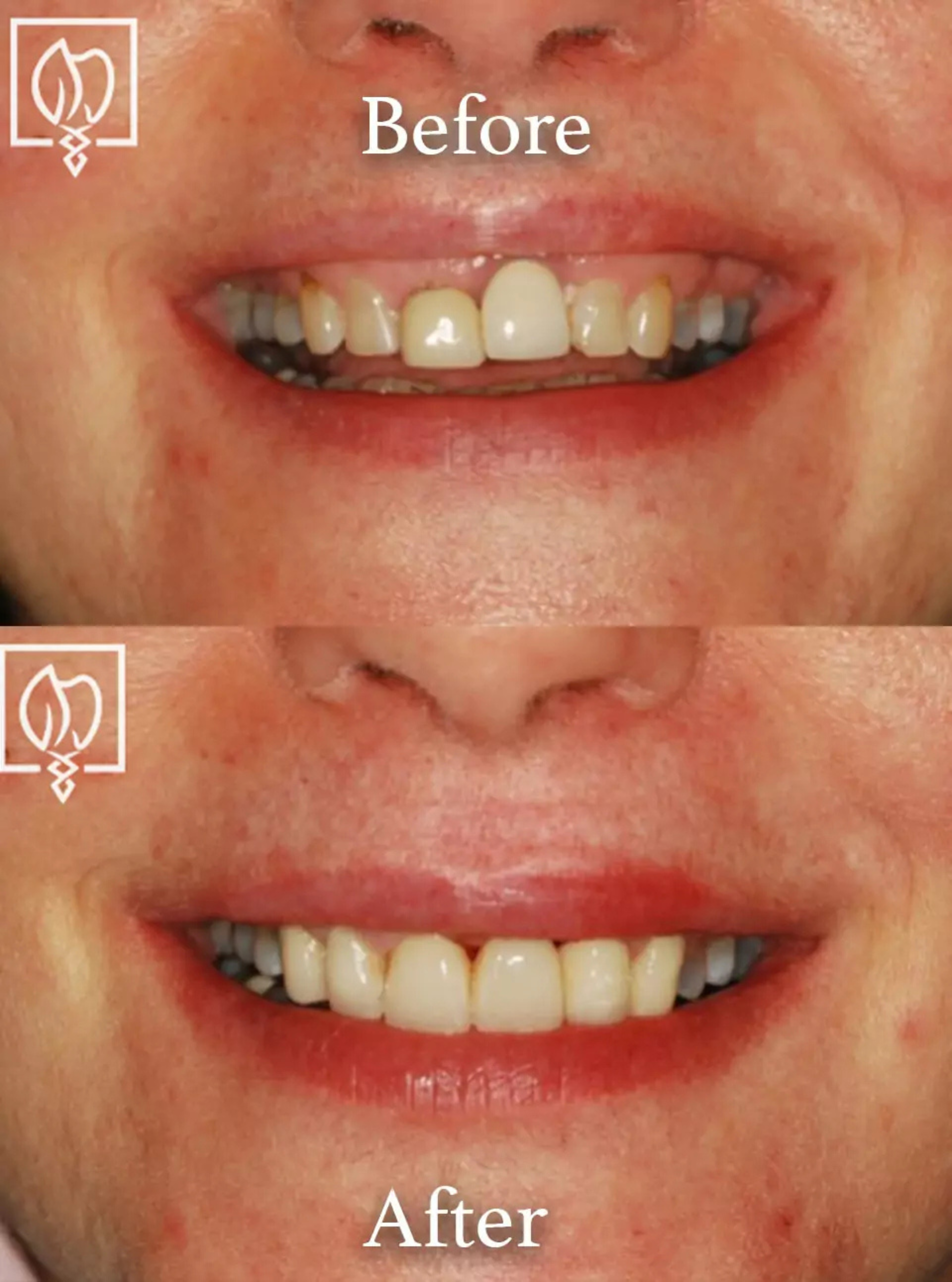 Cosmetic smile makeover before and after case 1