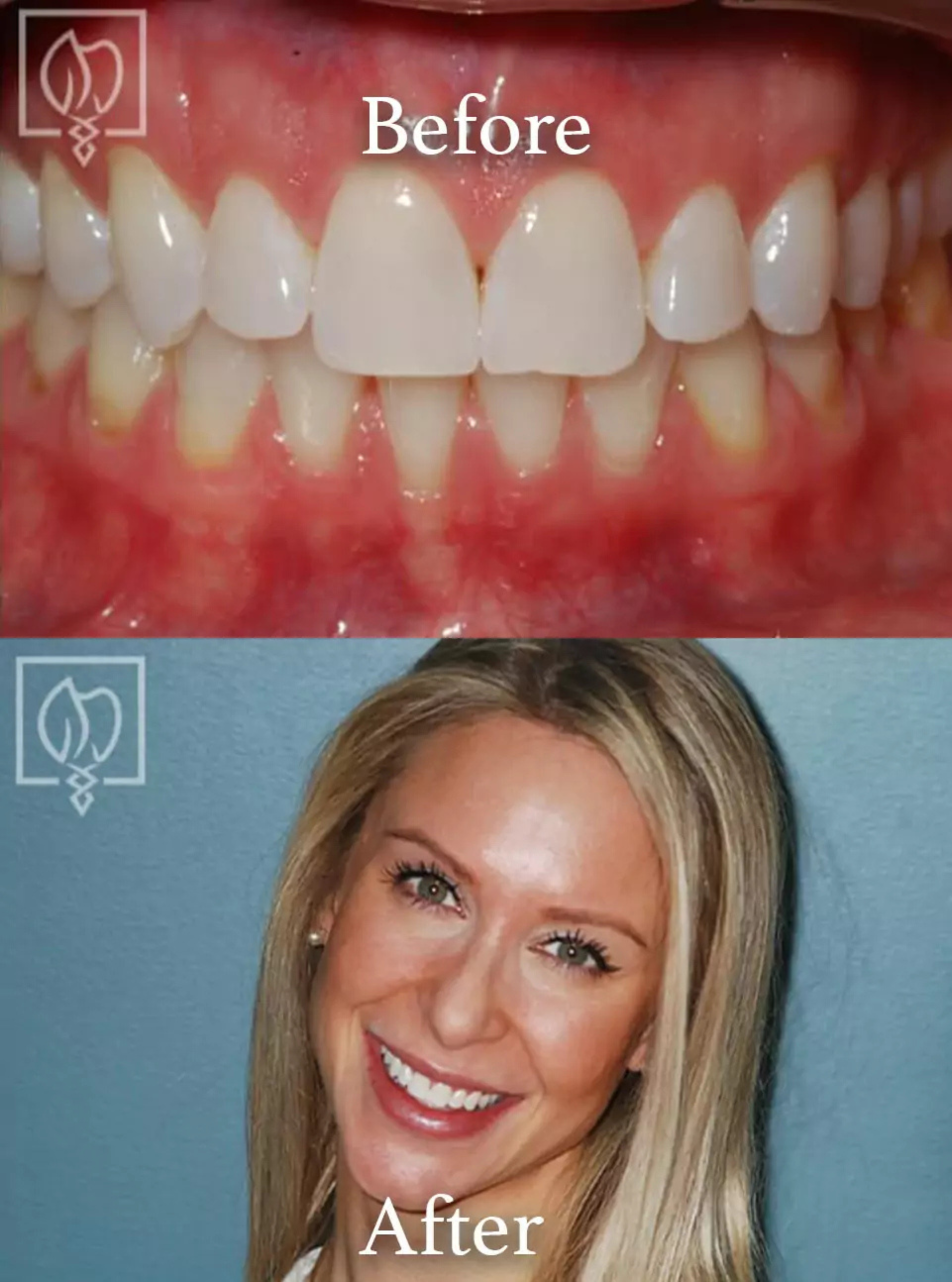Cosmetic smile makeover before and after case 2
