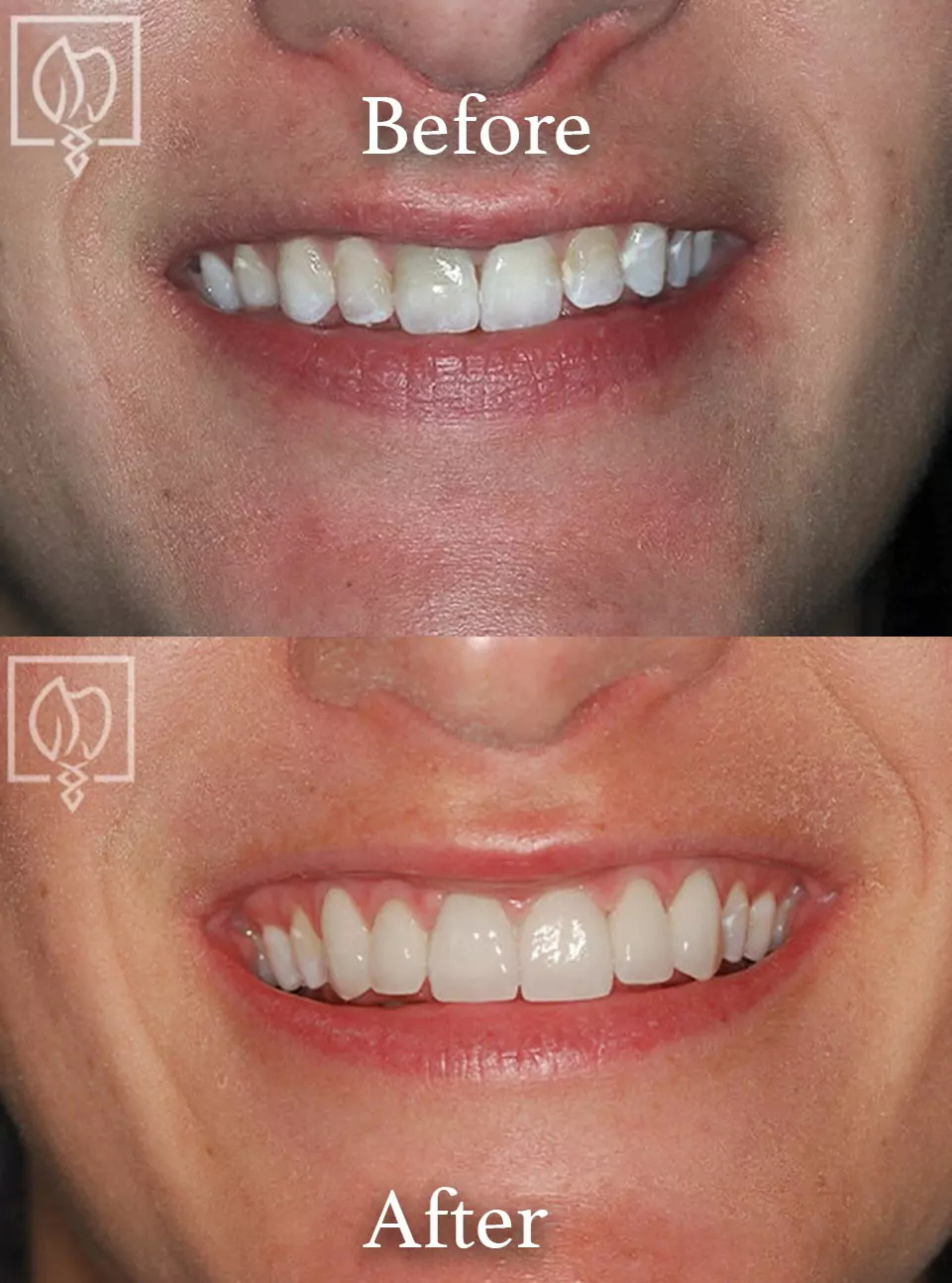 Cosmetic smile makeover before and after case 12