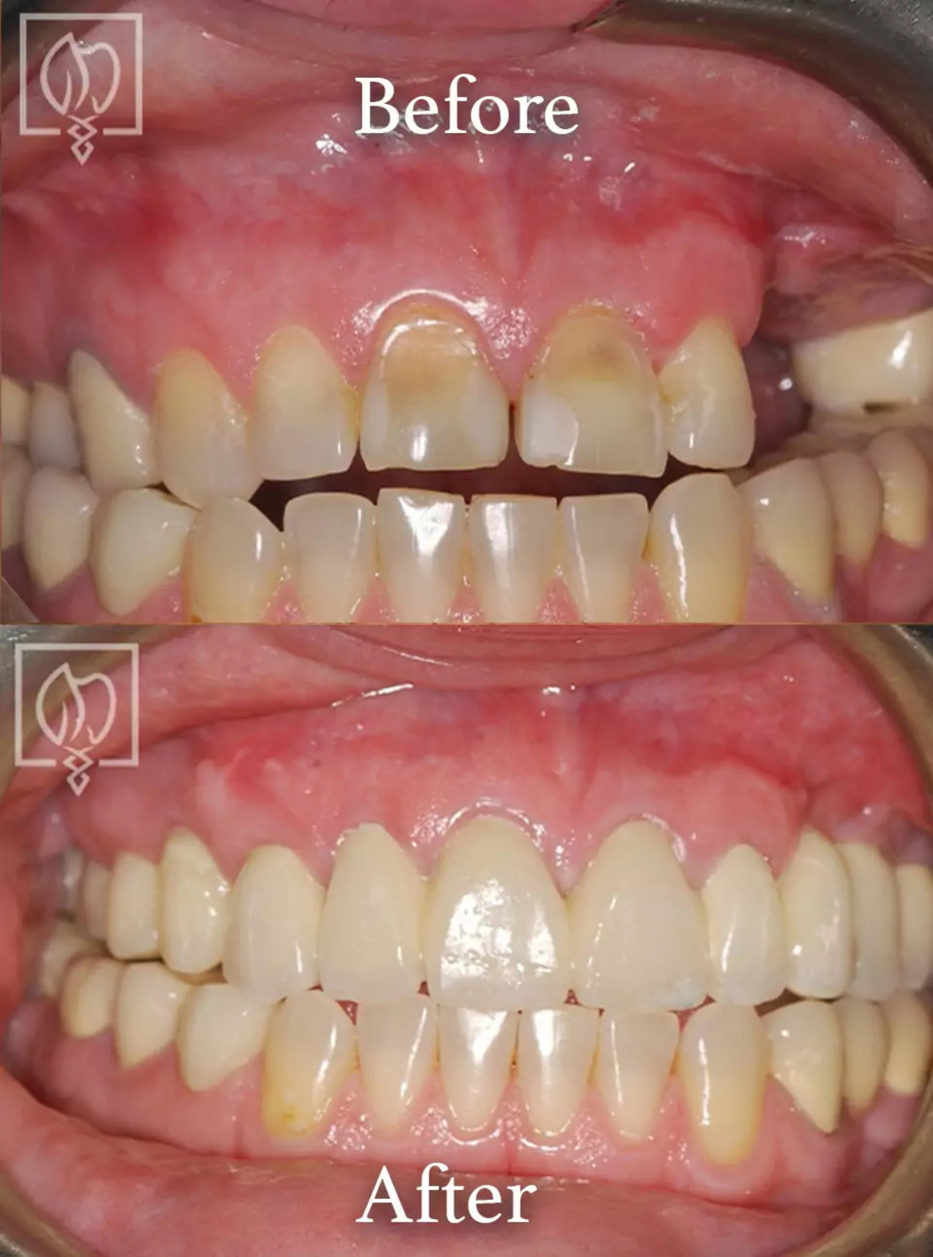 Dental implant surgery before and after case 1