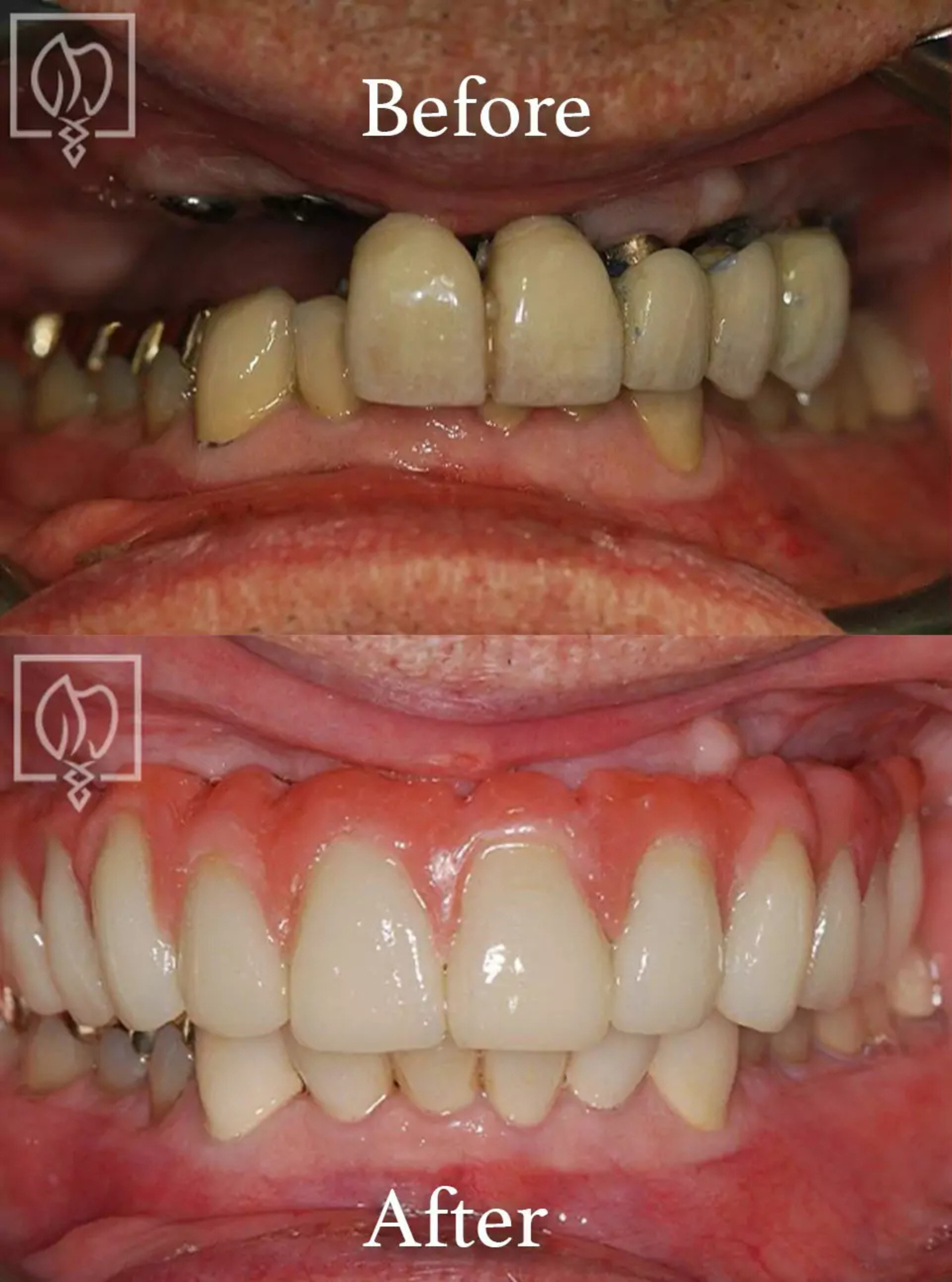 Dental implant surgery before and after case 3