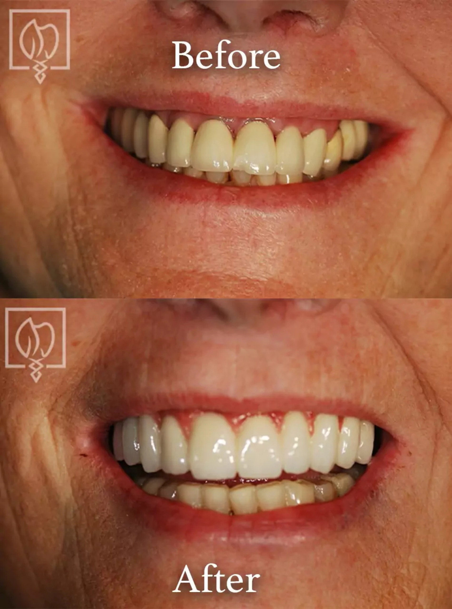 Dental implant surgery before and after case 4