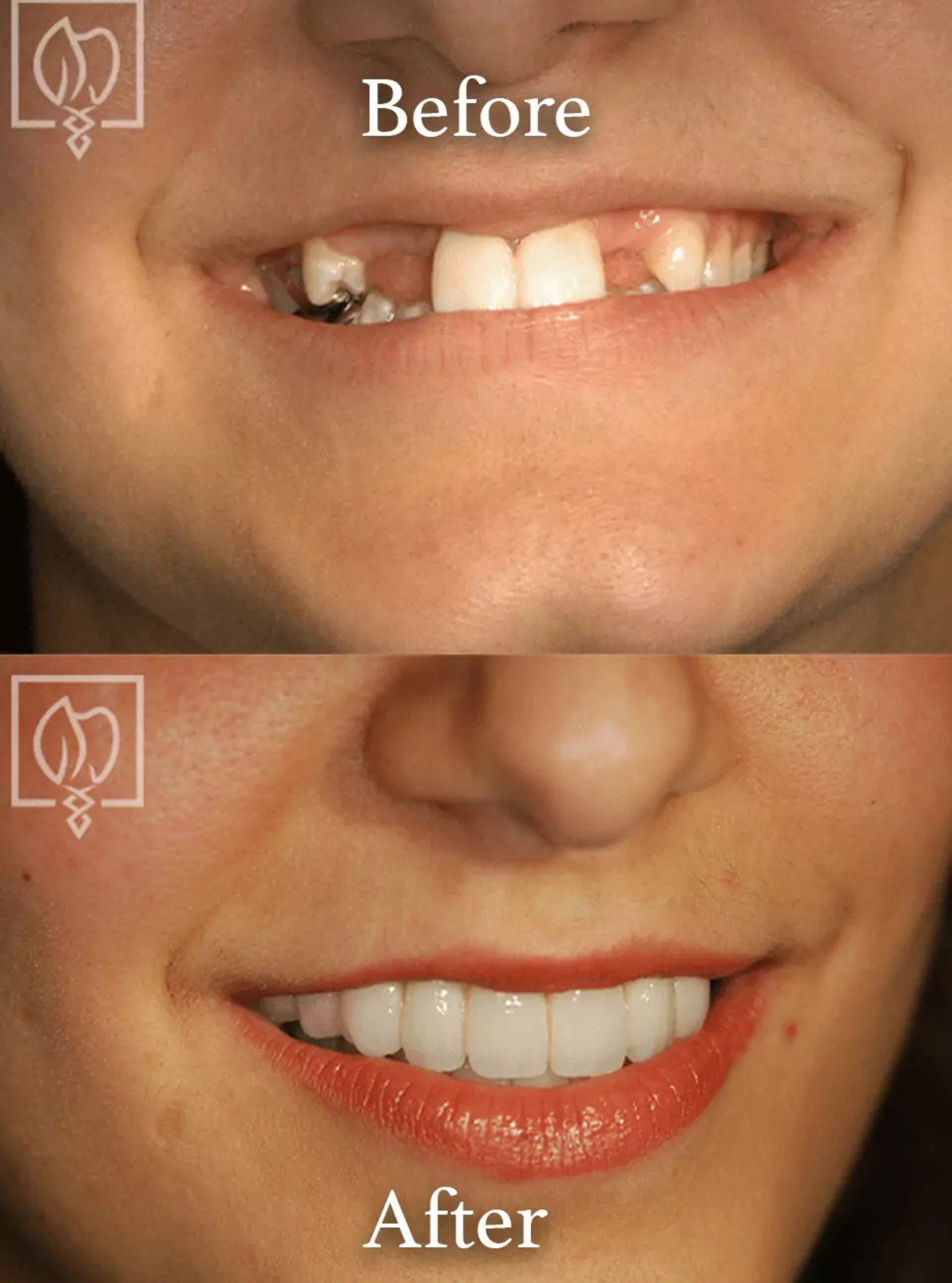 Dental implant surgery before and after case 5