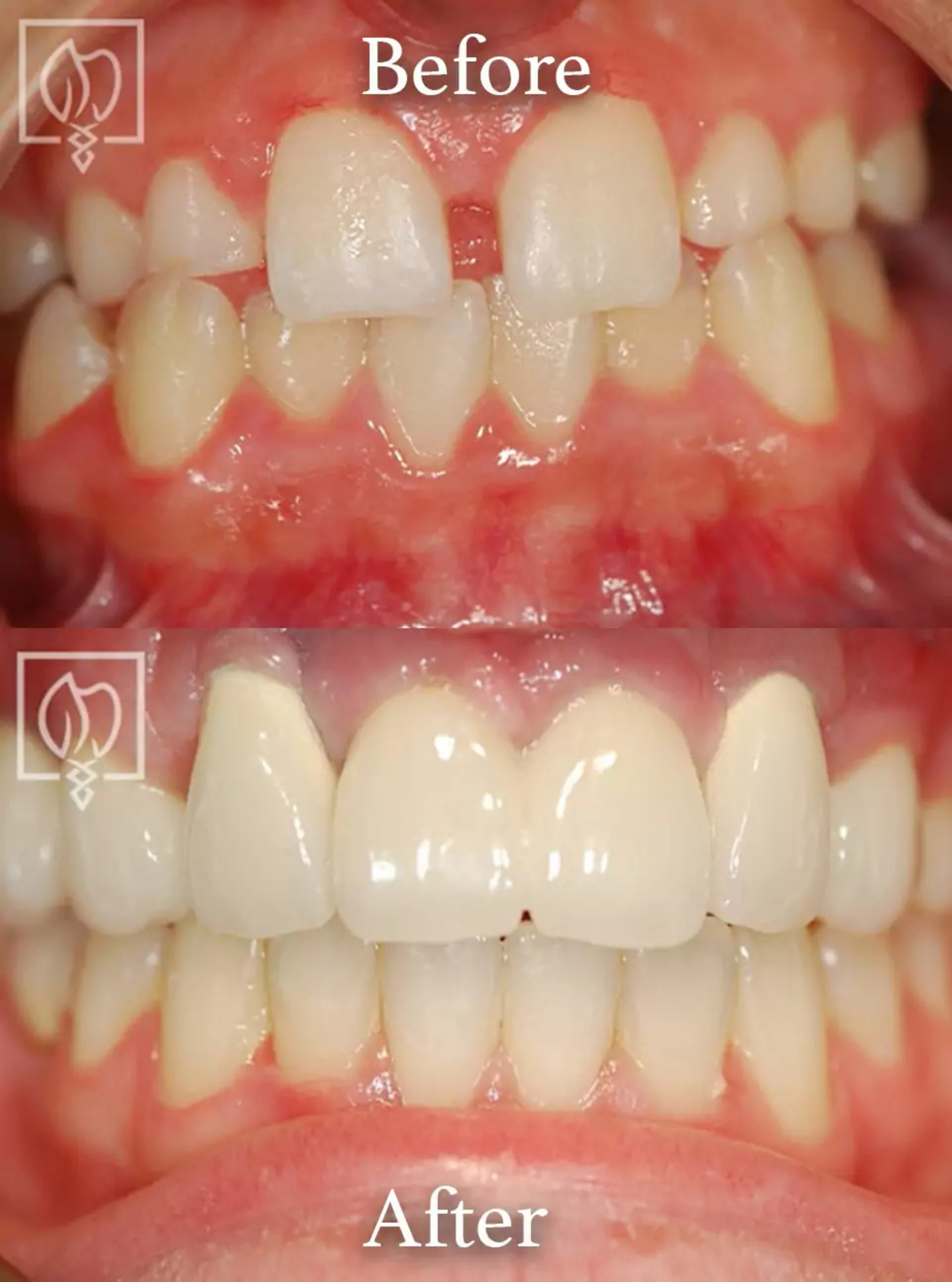 Dental implant surgery before and after case 6