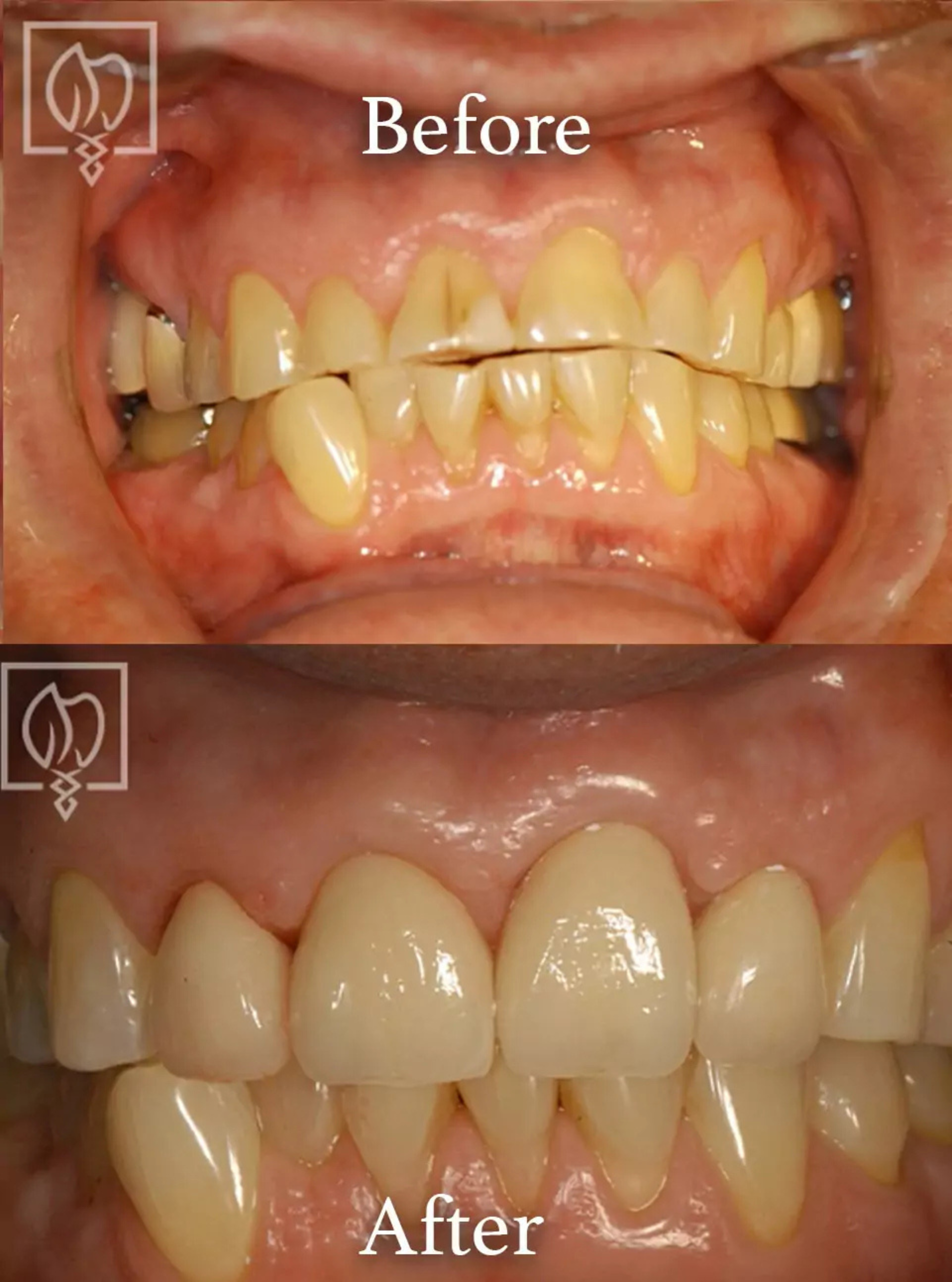 Discolored teeth correction before and after case 1
