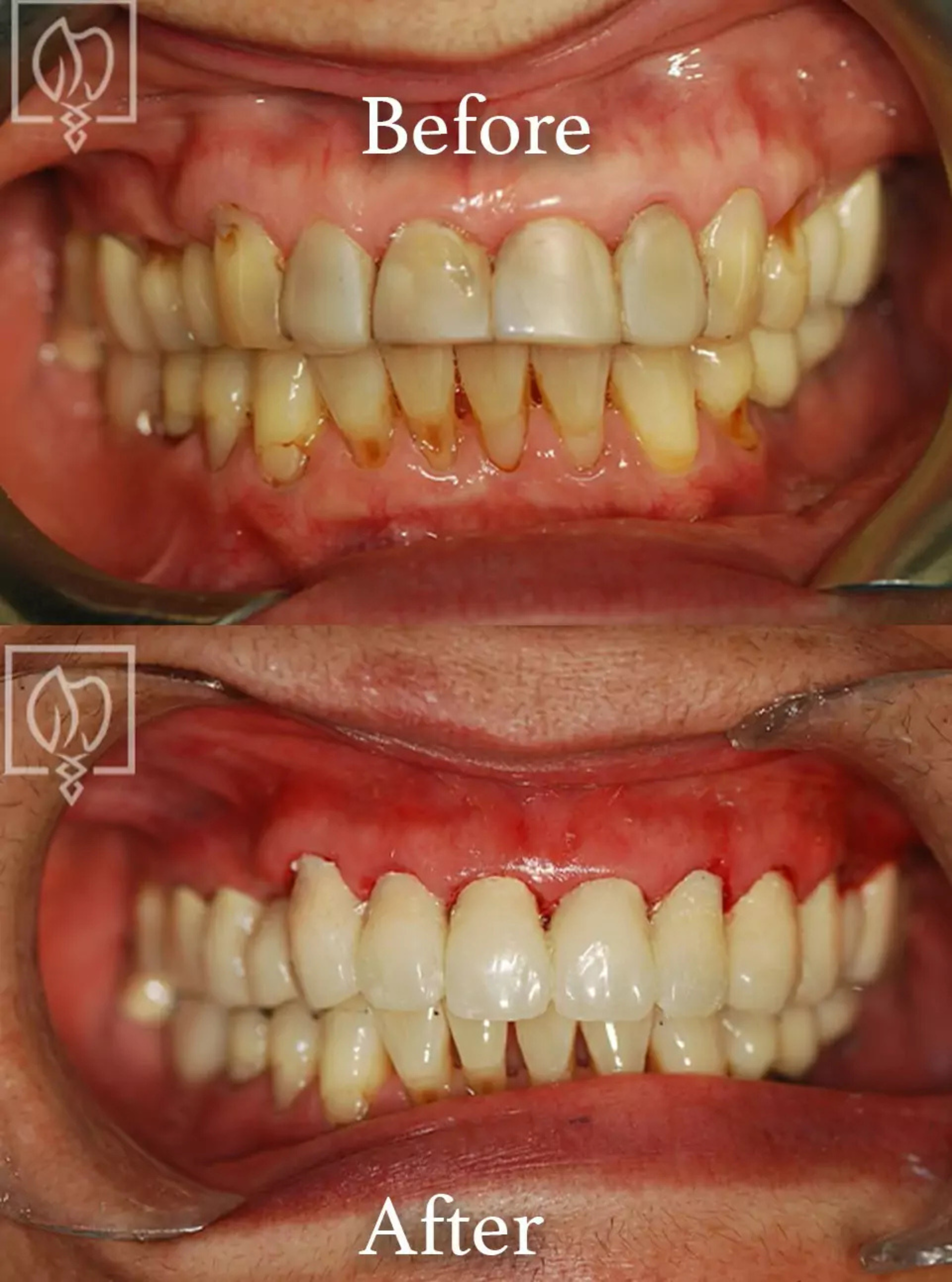 Discolored teeth correction before and after case 2