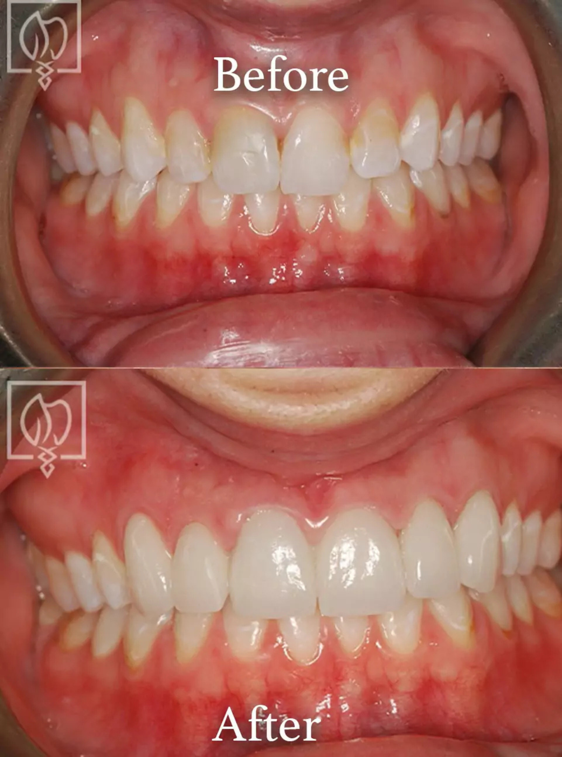 Discolored teeth correction before and after case 3