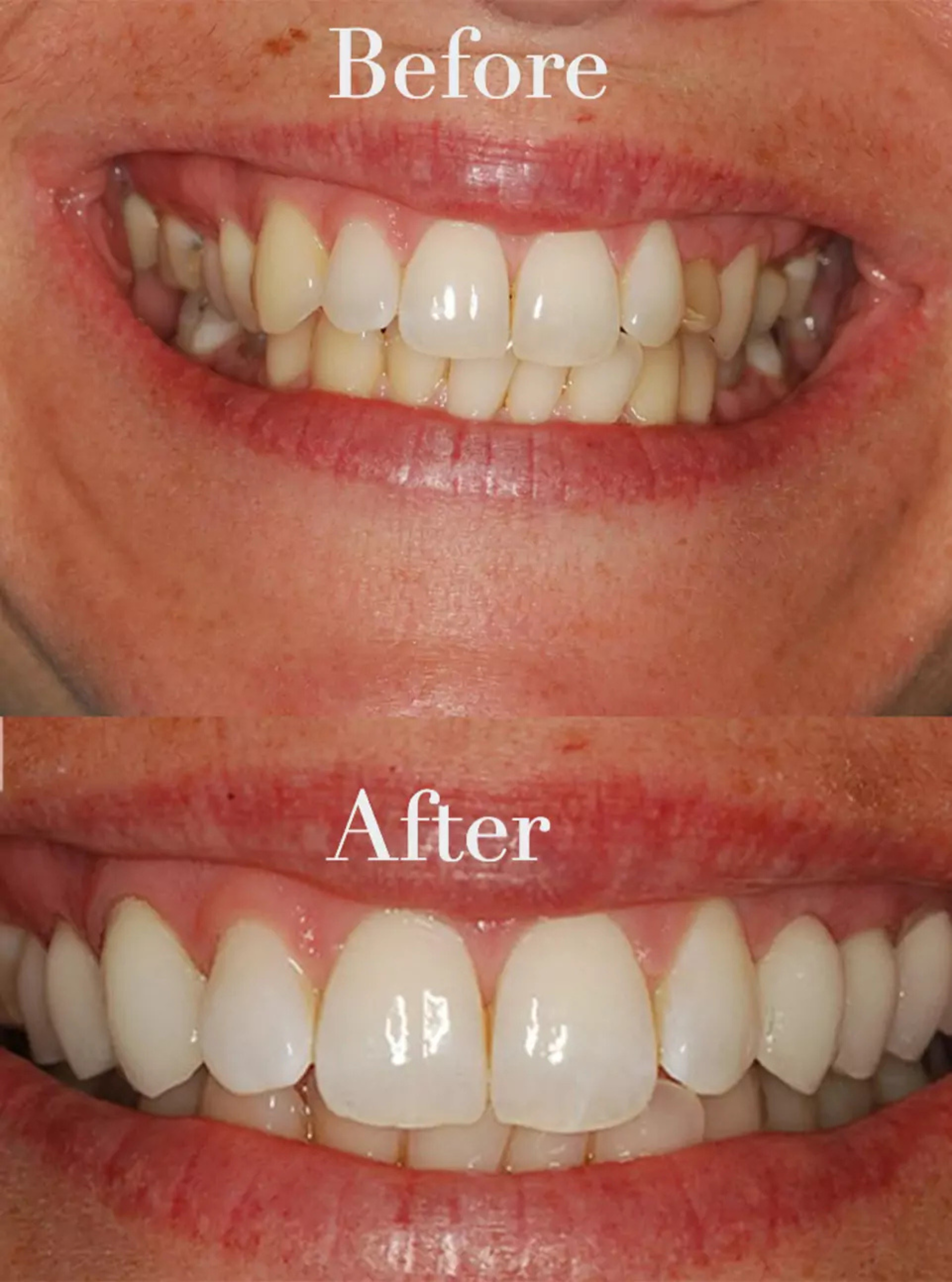 Discolored teeth correction before and after case 4