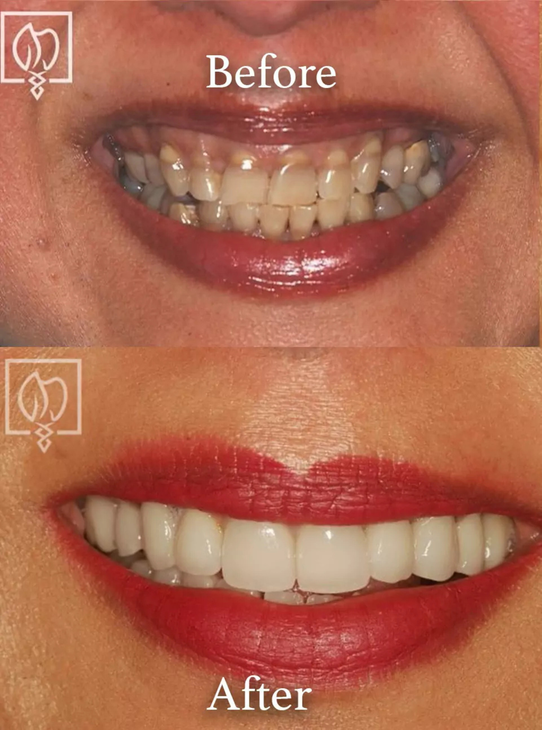 Discolored teeth correction before and after case 5
