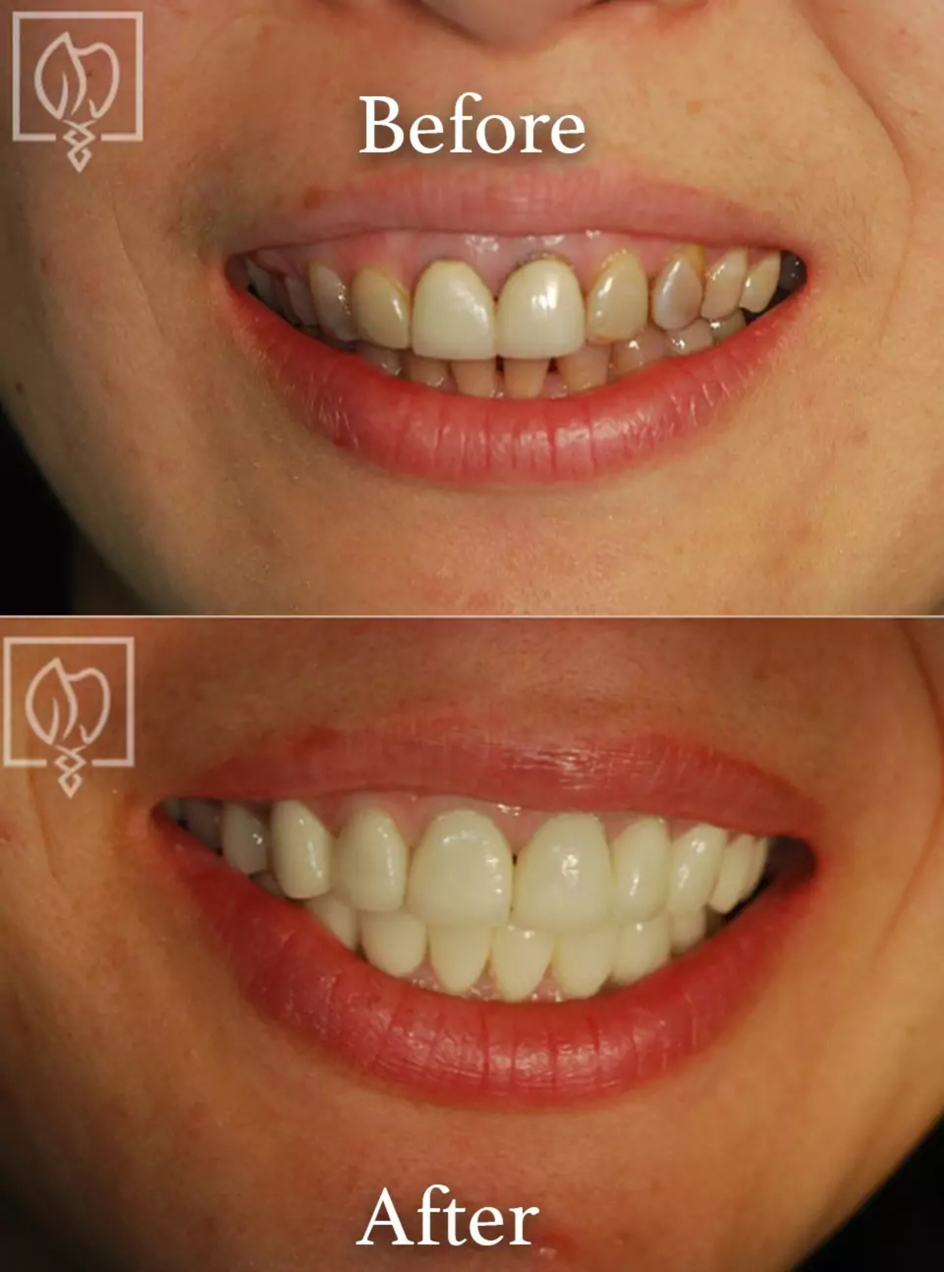 Discolored teeth correction before and after case 6