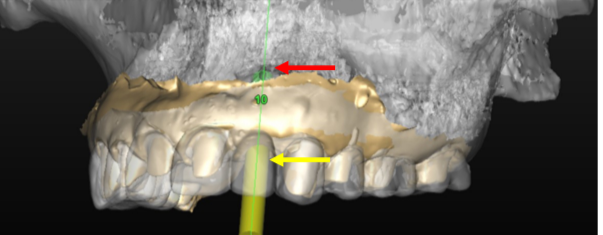Virtual implant placement on CT scan under a temporary crown