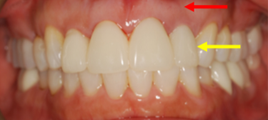 Design of the custom surgical guide