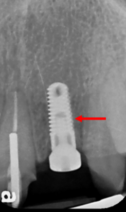 Surgical guide seated on teeth guiding drill