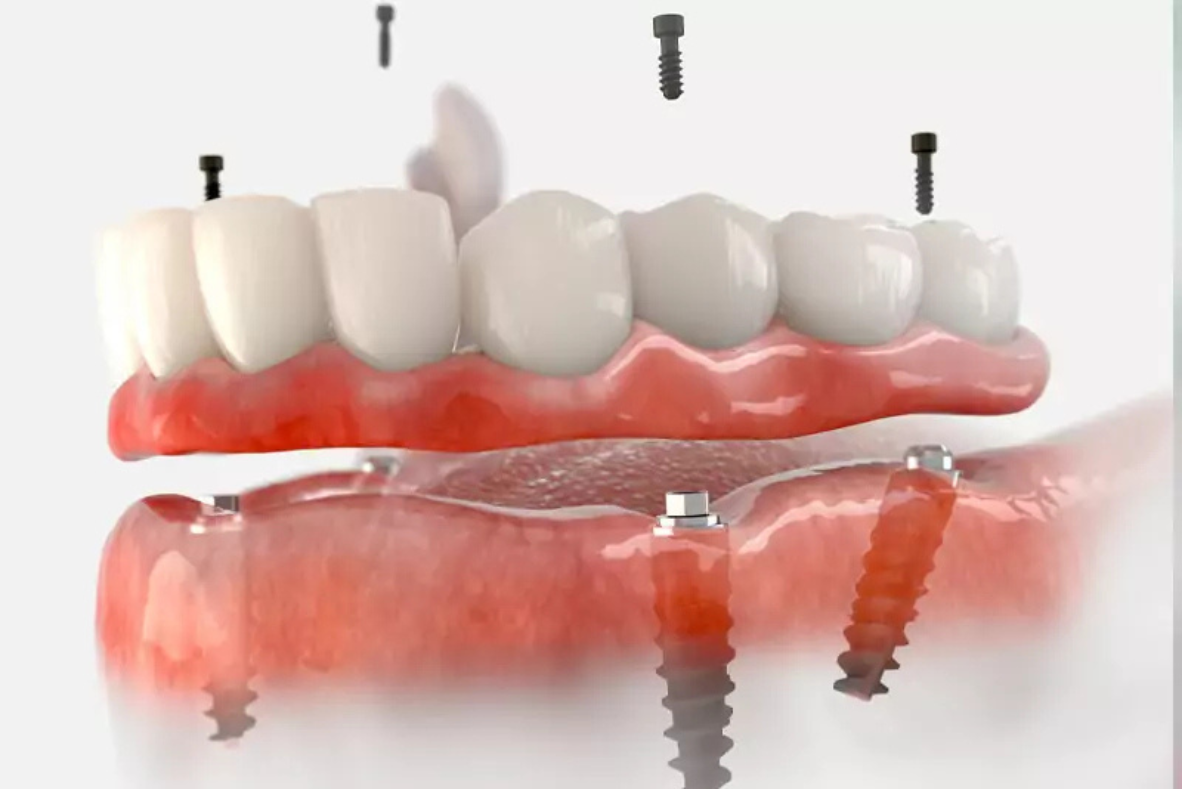Diagram showing full mouth dental implant restoration with fixed prosthesis