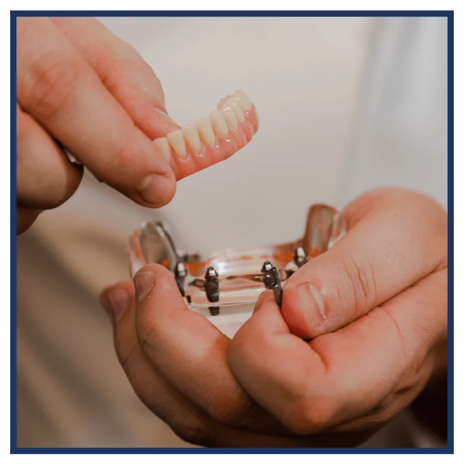 Illustration of full mouth dental implant placement and restoration