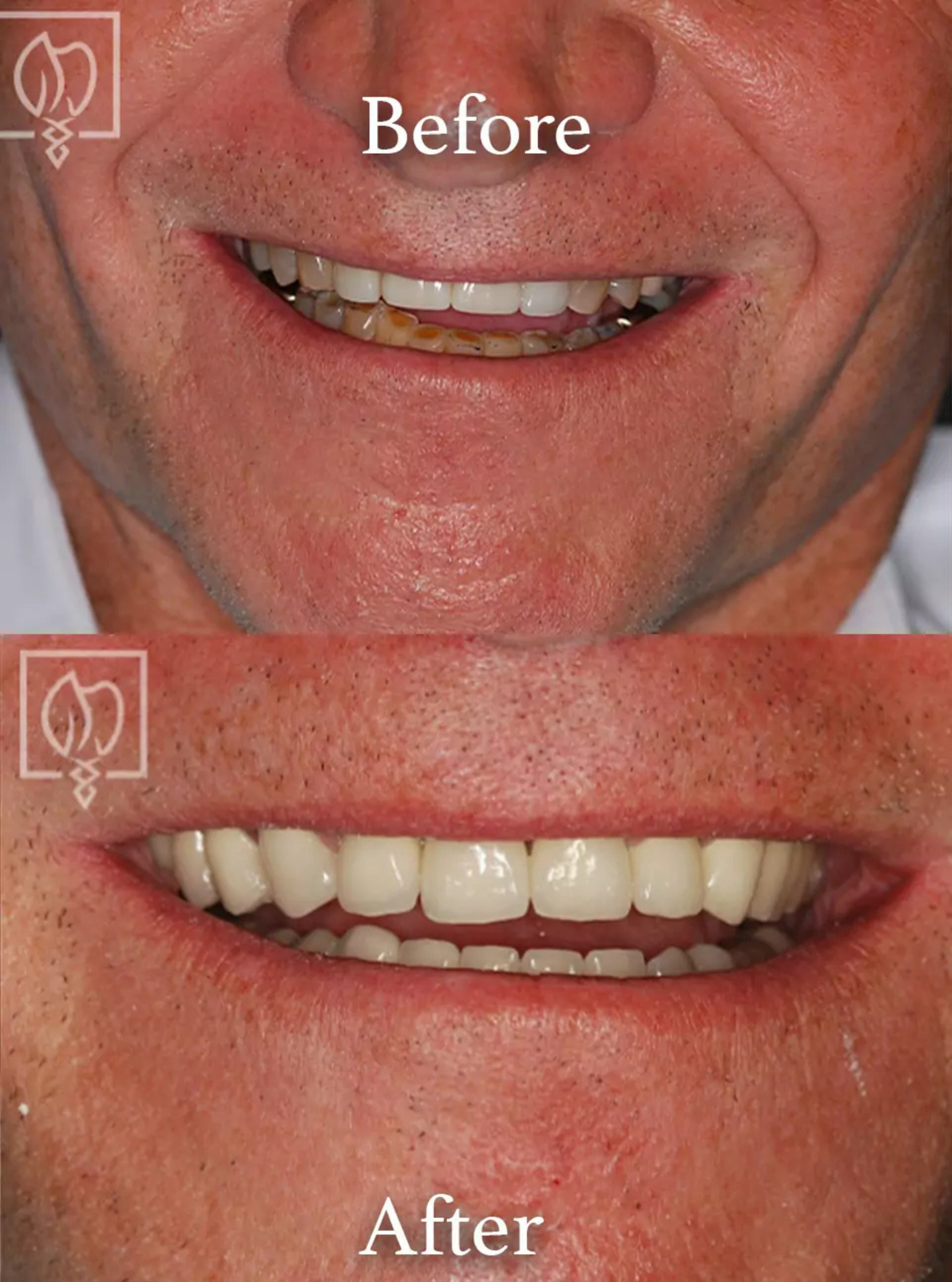 Full mouth reconstruction before and after case 1