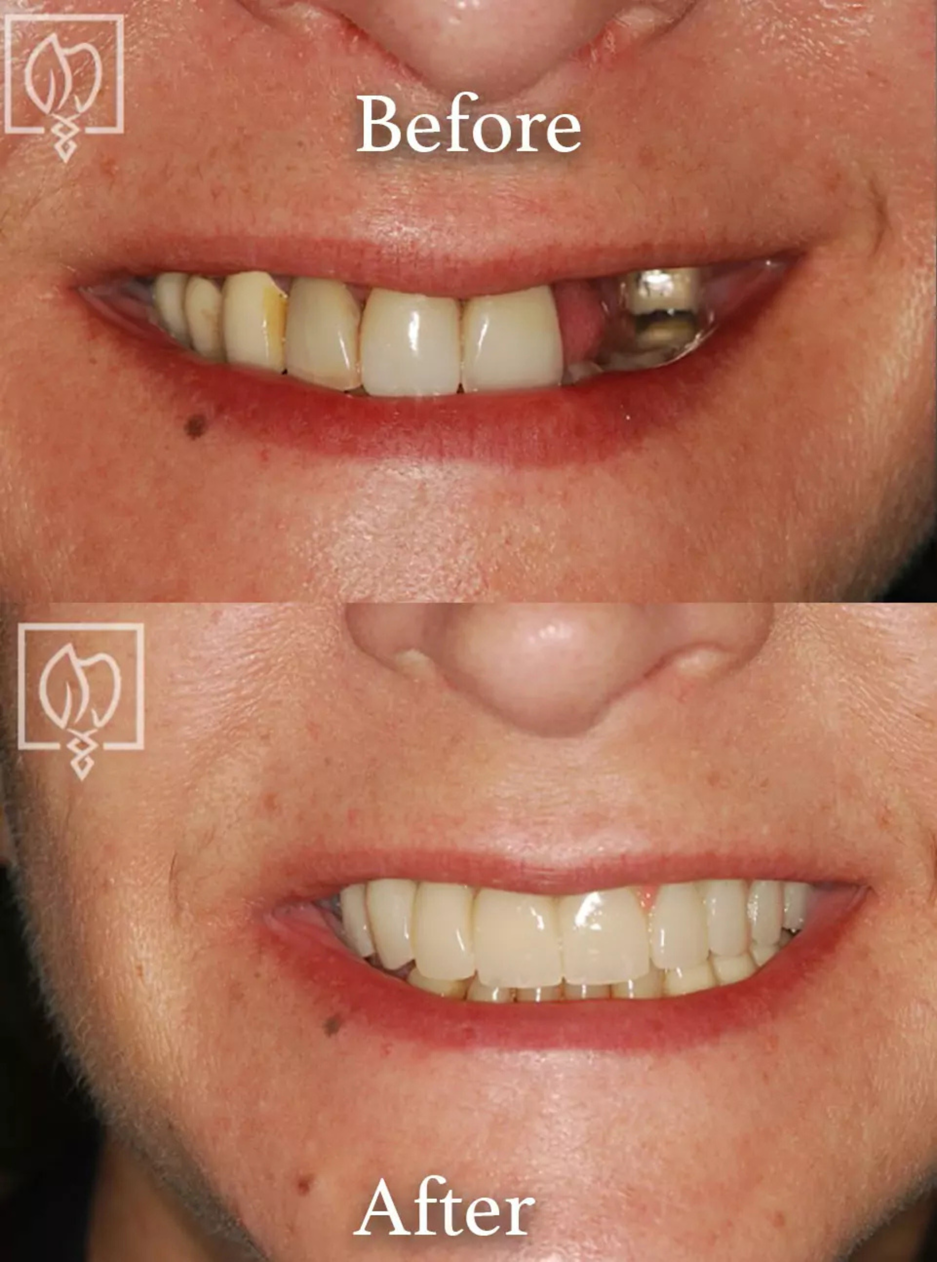 Full mouth reconstruction before and after case 2